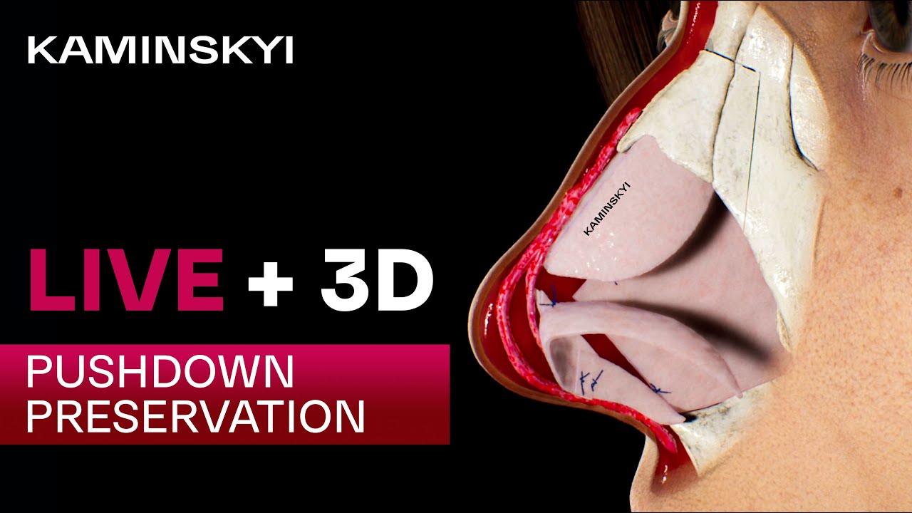 PUSHDOWN and PRESERVATION RHINOPLASTY in 3D with LIVE videos ★ EDGAR KAMINSKYI